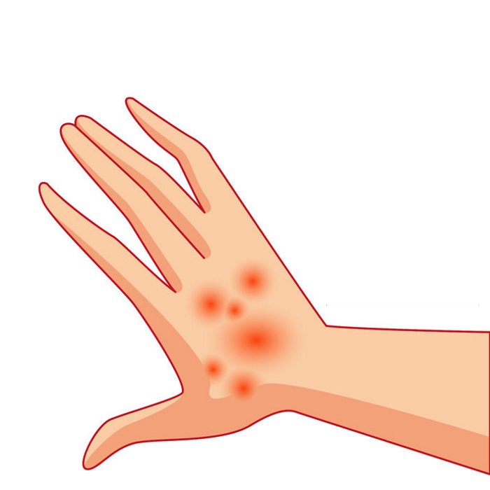 Polymorphic Erythema - Causes, Symptoms, Treatment and Evolution