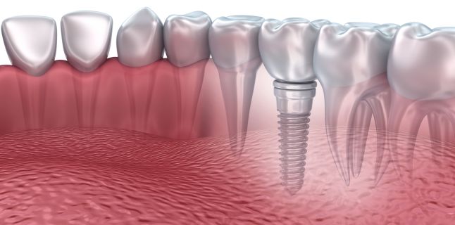 Zirconium Dental Implants vs Titan Implants