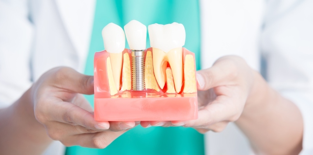 Dental implants - types, benefits and risks