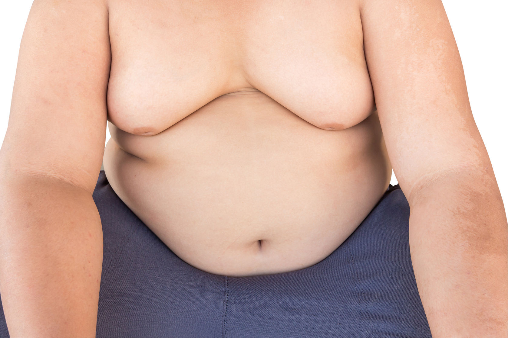 Prader Willi Syndrome or one of the causes of obesity in children