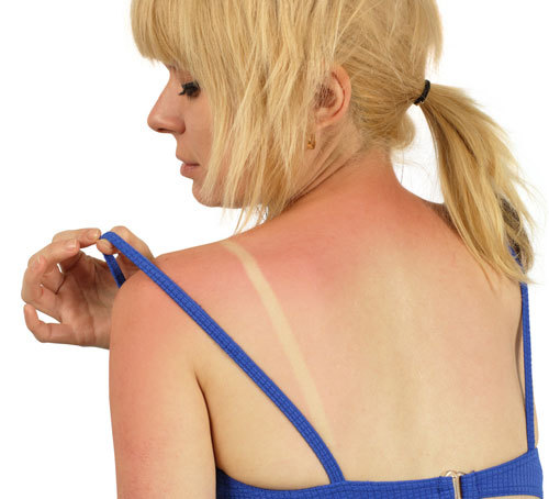3 remedies for sunburn