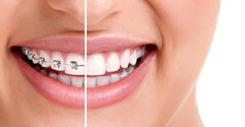 Зубной прибор - влияние на симметрию лица