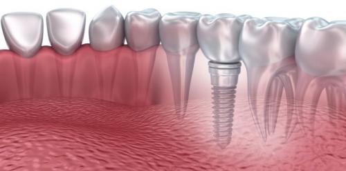 Implanturile Dentare din Zirconiu vs Implanturile din Titan