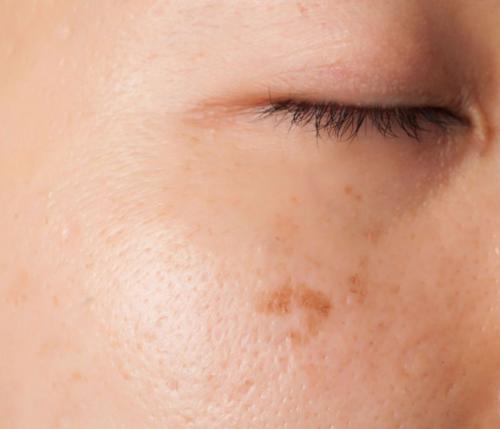 How do you get rid of the brown spots on your face?