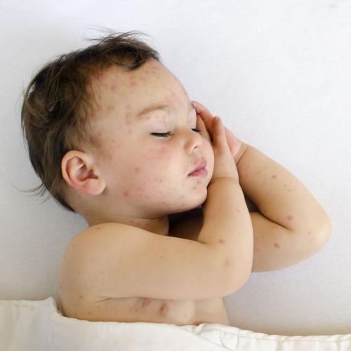 Chickenpox or vomiting: Symptoms, complications, prevention and treatment