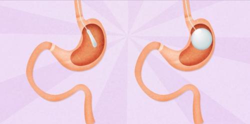 Gastric ring, solution against obesity