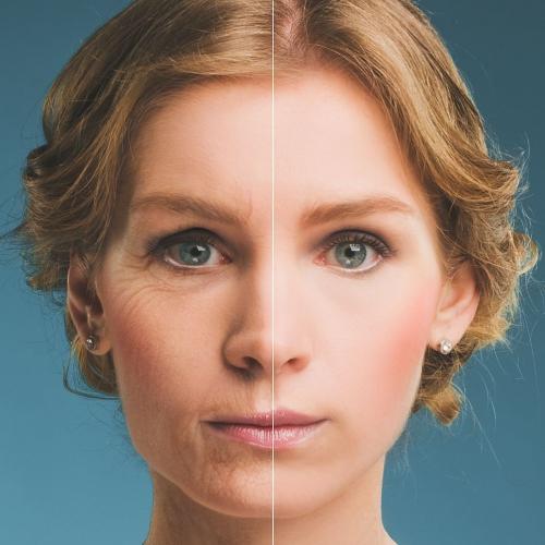 Mit sau adevăr  in estetica facială - despre acidul hialuronic