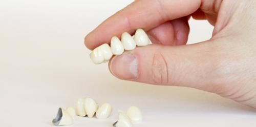 Crowns and dental bridges - advantages and disadvantages