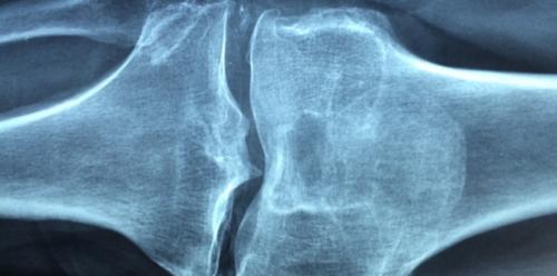 Признаки воспалительного артрита - как можно лечить?
