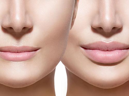 7 things you need to know about lip augmentation